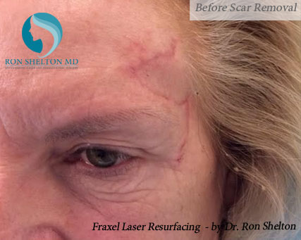fraxel-b-9 Before Scar Removal