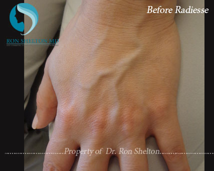 radiesse-lhand-before Before Radiesse