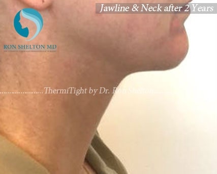 thermitight-a7 Jawline & Neck after 2 years