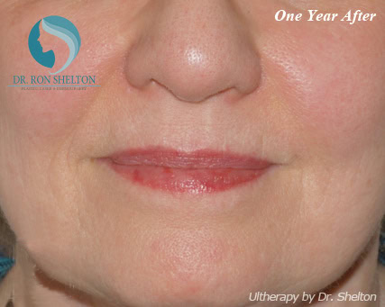 ultherapy-af-1 1 Year After Ultherapy