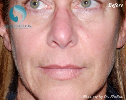 ultherapy-b-7 Fillers-radiesse-b-1