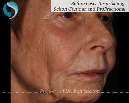 before-laser-resurfacing2 Photo of before laser resurfacing