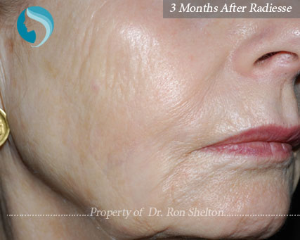 radiesse-a-1 3 months after Radiesse used for lines on lower face