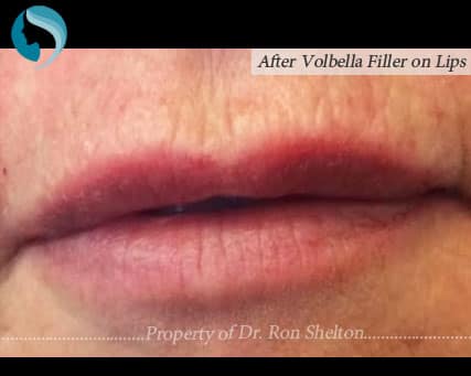 volbella-a-4-min Post operative Volbella immediate results
