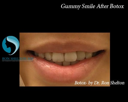 botox-a-10 Gummy Smile After Botox