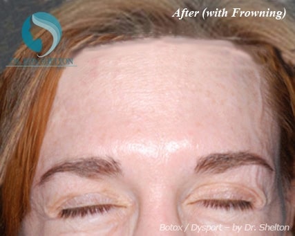 botox-a-2 After Botox (With Frowning)