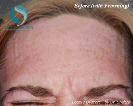 botox-b-2 Before Botox (With Frowning)
