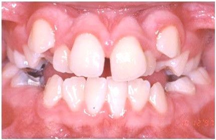 Misaligned or Rotated Teeth Diastema due rotated or misaligned teeth