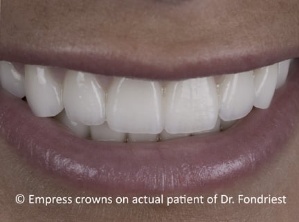 When the bite is designed well, any type of crown is able to stand up to grinding veneers for bruxers