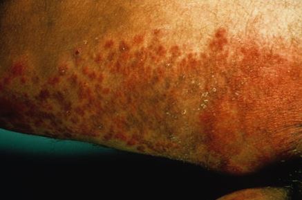 Skin Candidiasis