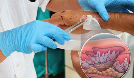 An Approach to Wound Care in the Urgent Care Setting An Approach to Wound Care in the Urgent Care Setting