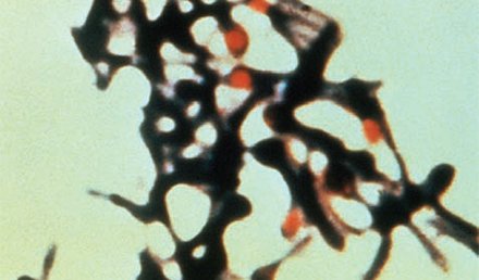 A 25-Year-Old Male Presenting with Tetanus A 25-Year-Old Male Presenting with Tetanus