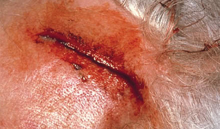Common Lacerations of the Head Common Lacerations of the Head