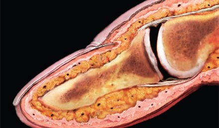 Assessment and Initial Care of Fingertip and Nailbed Injuries Assessment and Initial Care of Fingertip and Nailbed Injuries