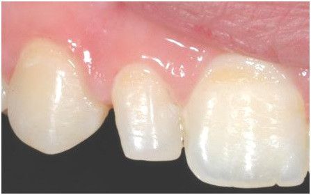 Diastema due to Small Sized teeth Gap in Teeth Treatment in Gurgaon