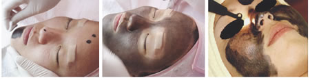 Spectra Laser Treatment For Treatment Of Acne Wrinkles And Melasma In Singapore