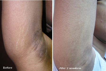 Derma Roller For Stretch Marks Microneedling Treatments Luxe Luminous