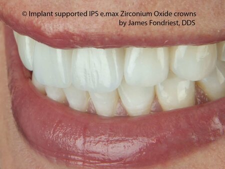 Strongest Implant crowns Strongest Implant crowns