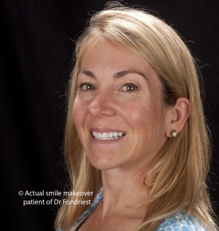Cosmetic treatment planning Artistic Smile Design process