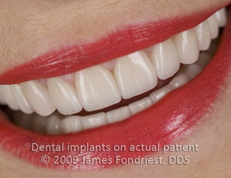 Implant supported Empress crowns Mixed natural and Implant crowns