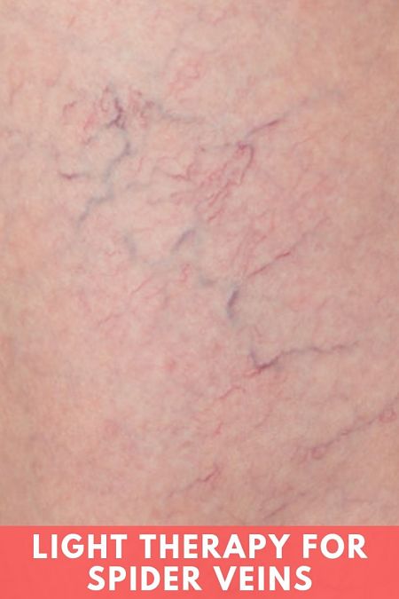 Light Therapy For Spider Veins Exterminate Them Quick Luxe Luminous