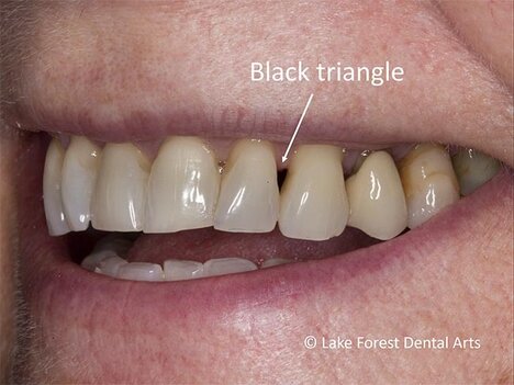 Even minor loss of gum tissue from between teeth can cause significant dark areas in a smile Lost Gum papillae from between teeth