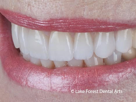 Veneers for grinders Veneers for Bruxism