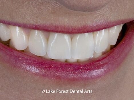 Cosmetic Dentistry by Dr.James Fondriest Crowns done by Chicago cosmetic dentist