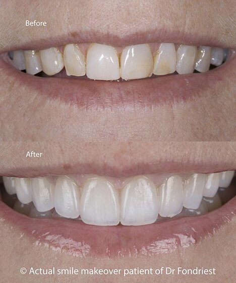 replacing old composite bonding with porcelain veneers Replacing old composite bonding