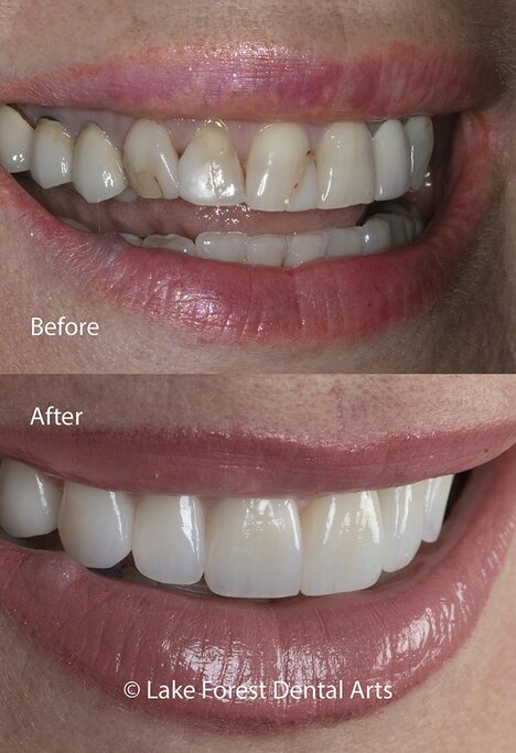 Smile makeover case done by Dr. Fondriest cosmetic dentistry pictures