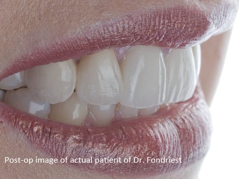Dental Bridgework PFM dental bridgework