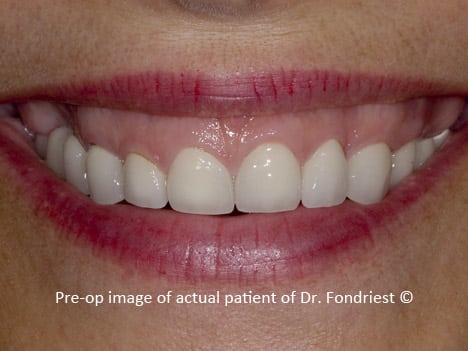 gummy smile that can be improved by gum lift Fix a Gummy Smile