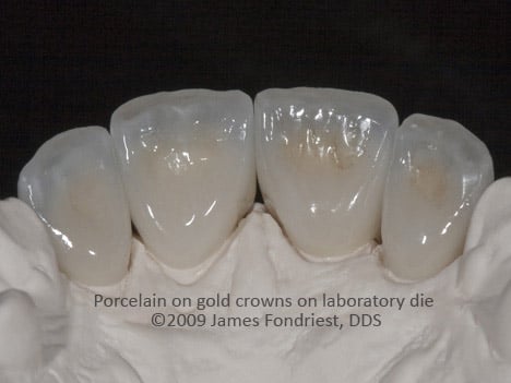 What PFM crowns look like from the back side PFM crowns
