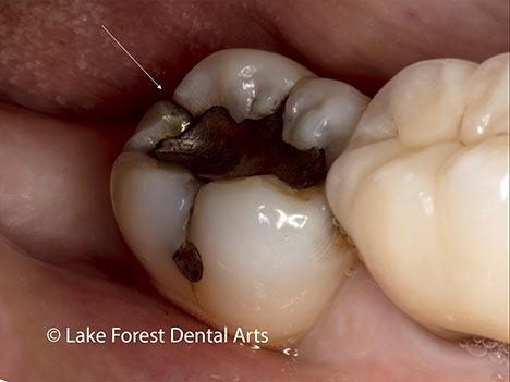 cracked tooth