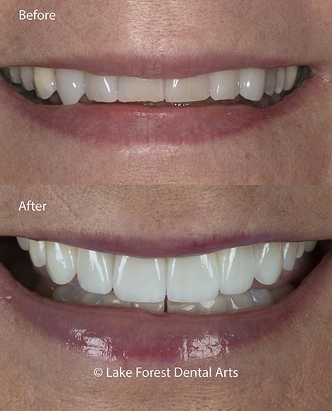 bruxism treatment with veneers