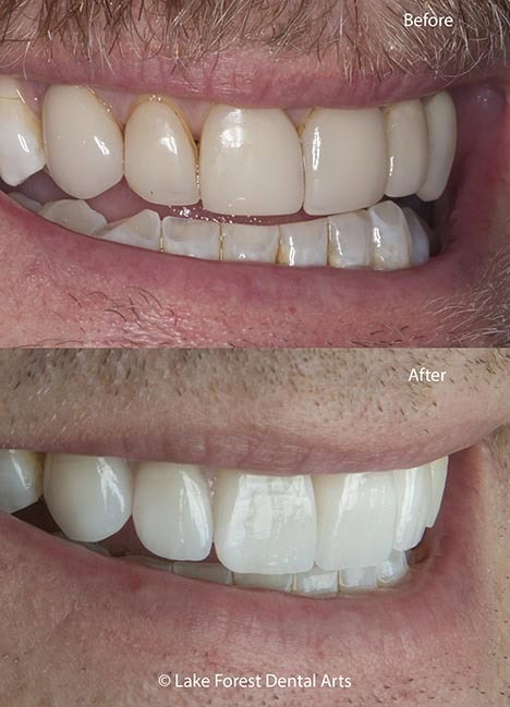 Brighter and more natural teeth tooth veneers before and after