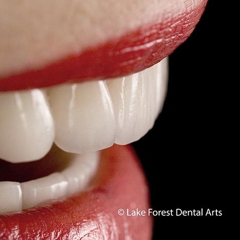 Disadvantages Of Dental Bridges Requires Drilling Of Teeth