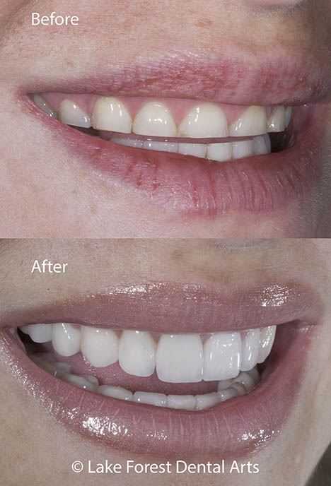 smile makeover done by Dr Fondriest short teeth fixed before and after