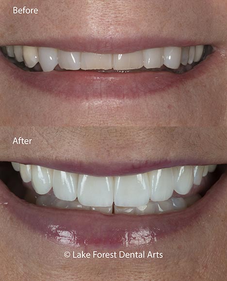 porcelain veneers before and after porcelain veneers before and after