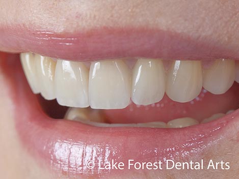 This smile makeover was done with a great deal of patient involvement. She described in great detail how she wanted her crowns to look. collaborative cosmetic dentistry