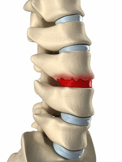 Degeneration Durch degenerierende Erkankungen wie Morbus Bechterew oder überlastete Bandscheiben bilden sich Knochenwucherungen sogenannte Osteophyten. Damit versucht der Körper den Verschleiß zu kompensieren.