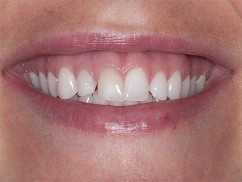 crown lengthening will raise the gum line