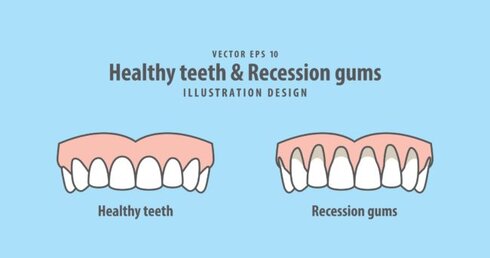 gum recession