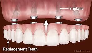 why dental implant bridges are better than dentures