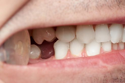 I Lost a Tooth... What Now? 6 Tooth Replacement Options