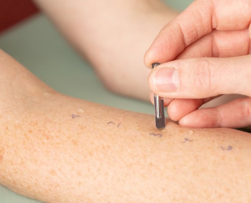 Durchführung eines Pricktest in der Allergologie