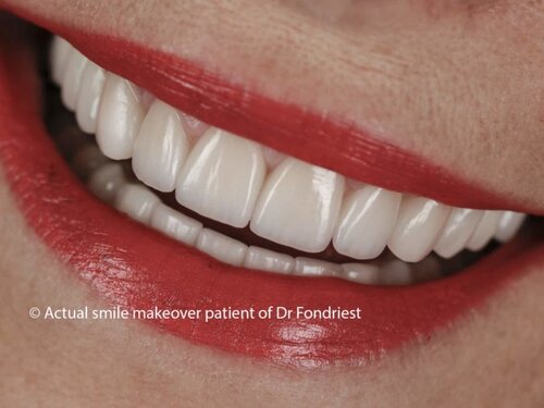 Common Dental Implant Mistakes