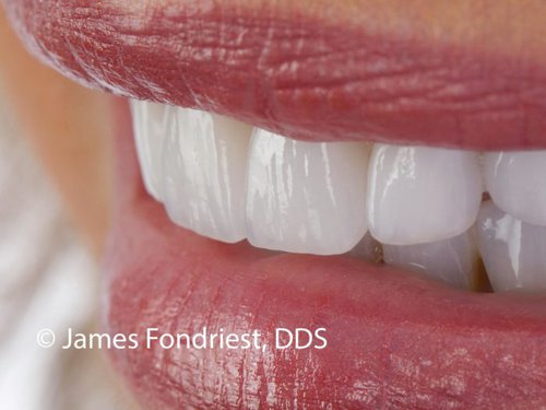 Porcelain crowns after restorations created by the prettitest Crown Materials