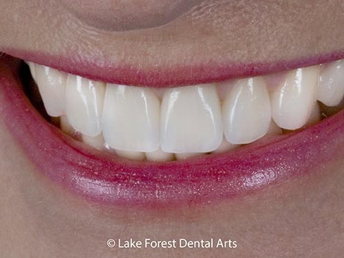 Beautiful cosmetic dentistry done by one of the best Chicago cosmetic dentists best Chicago cosmetic dentist