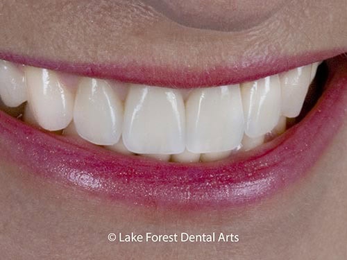 Cosmetic Dentistry by Dr.James Fondriest Crowns done by Chicago cosmetic dentist